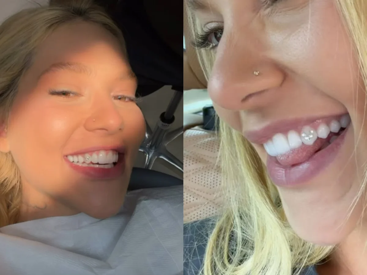 Joia nos dentes: dentista alerta sobre risco de tendência entre influencers